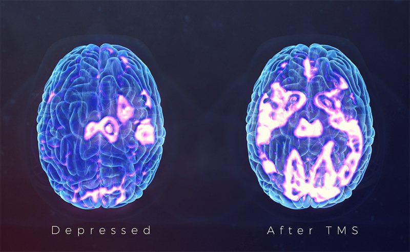Treatment Resistant Depression